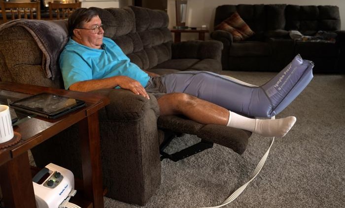 Imagen: Mike Kovach, un sobreviviente de cáncer de vejiga de 71 años de Shelby, Ohio, usa una bomba para reducir la hinchazón causada por el linfedema, un efecto secundario de su tratamiento contra el cáncer (fotografía cortesía del Centro Integral del Cáncer de la Universidad Estatal de Ohio).